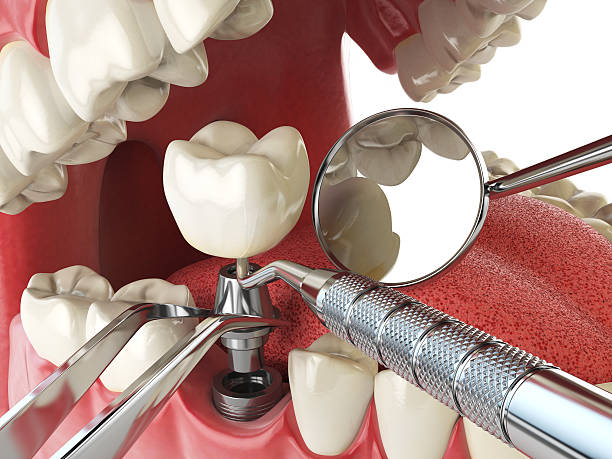 Best Emergency Dentist for Lost Fillings or Crowns in Akron, IA